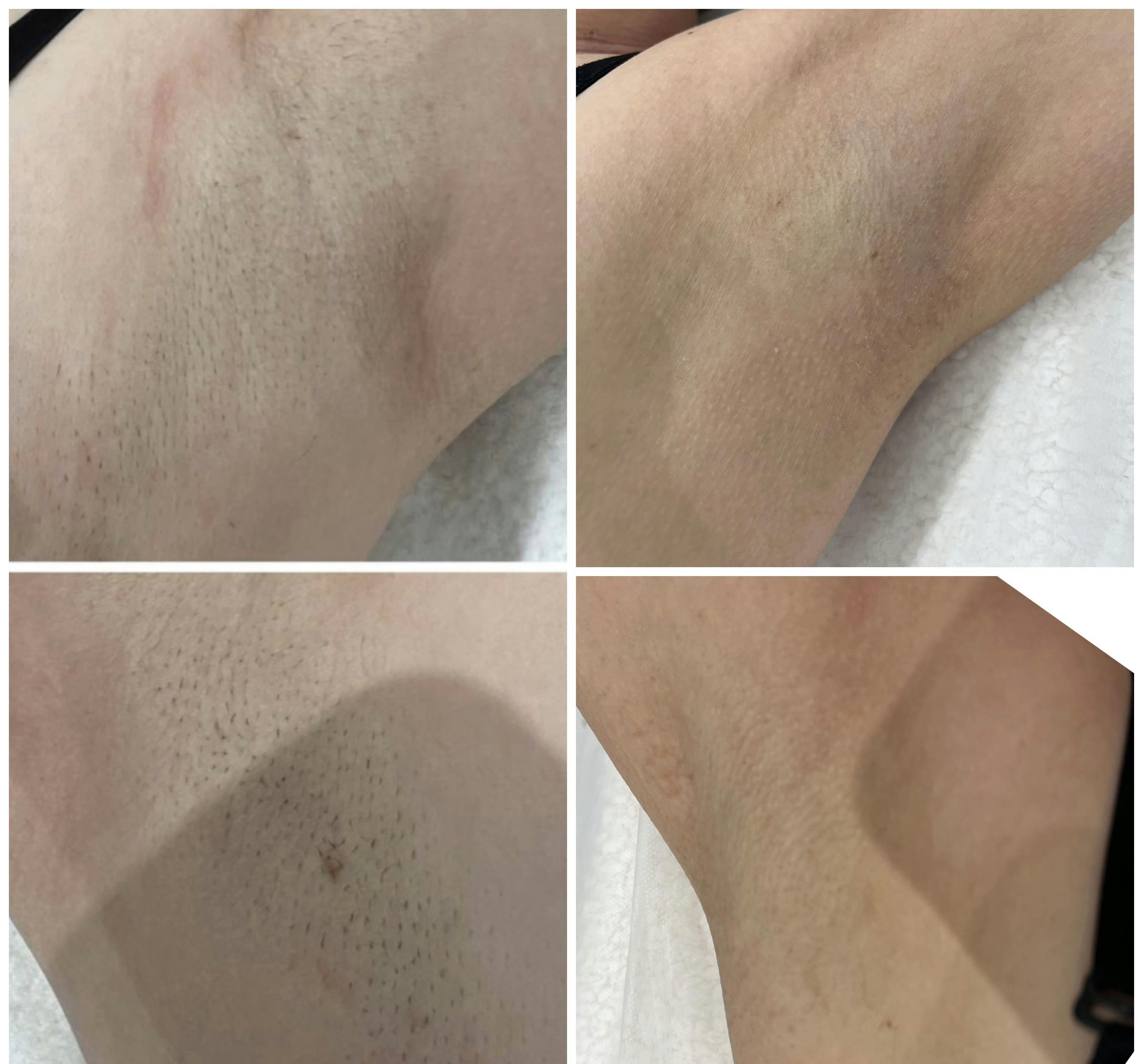 Лазерна епіляція Candela Gentle Max Pro
