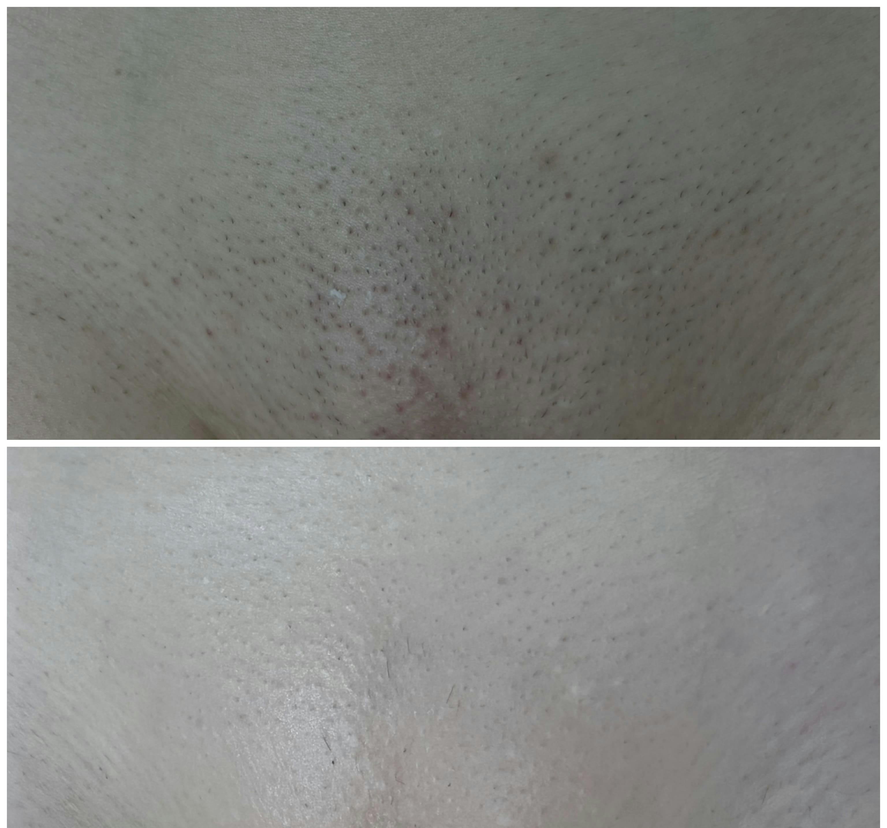 Лазерна епіляція Candela Gentle Max Pro