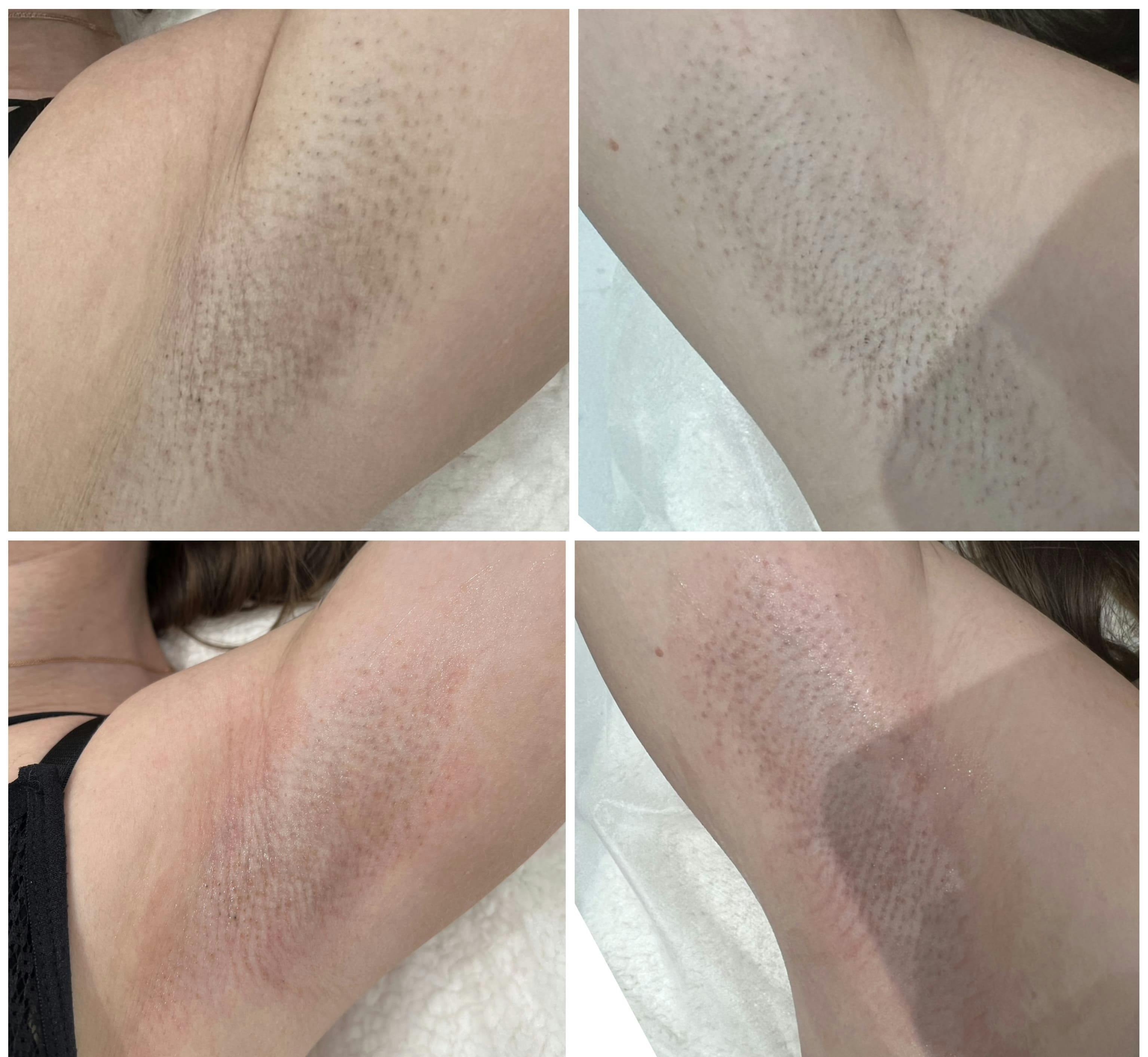 Лазерна епіляція Candela Gentle Max Pro
