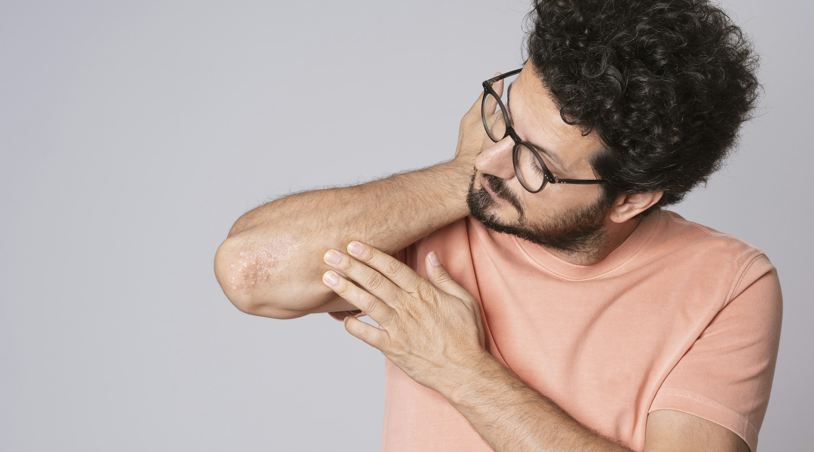 Itching for a new treatment? Cannabinoids show potential in psoriasis management Itching for a new treatment? Cannabinoids show potential in psoriasis management