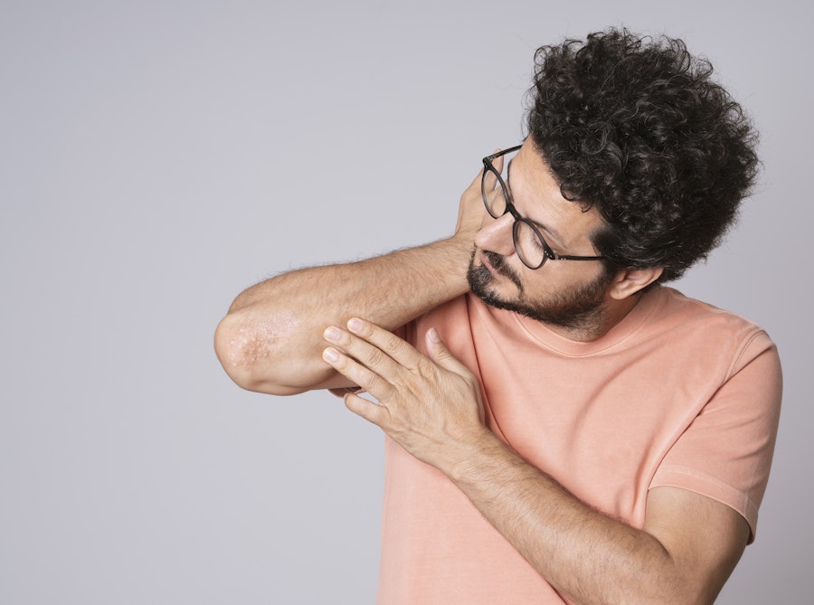 Itching for a new treatment? Cannabinoids show potential in psoriasis management