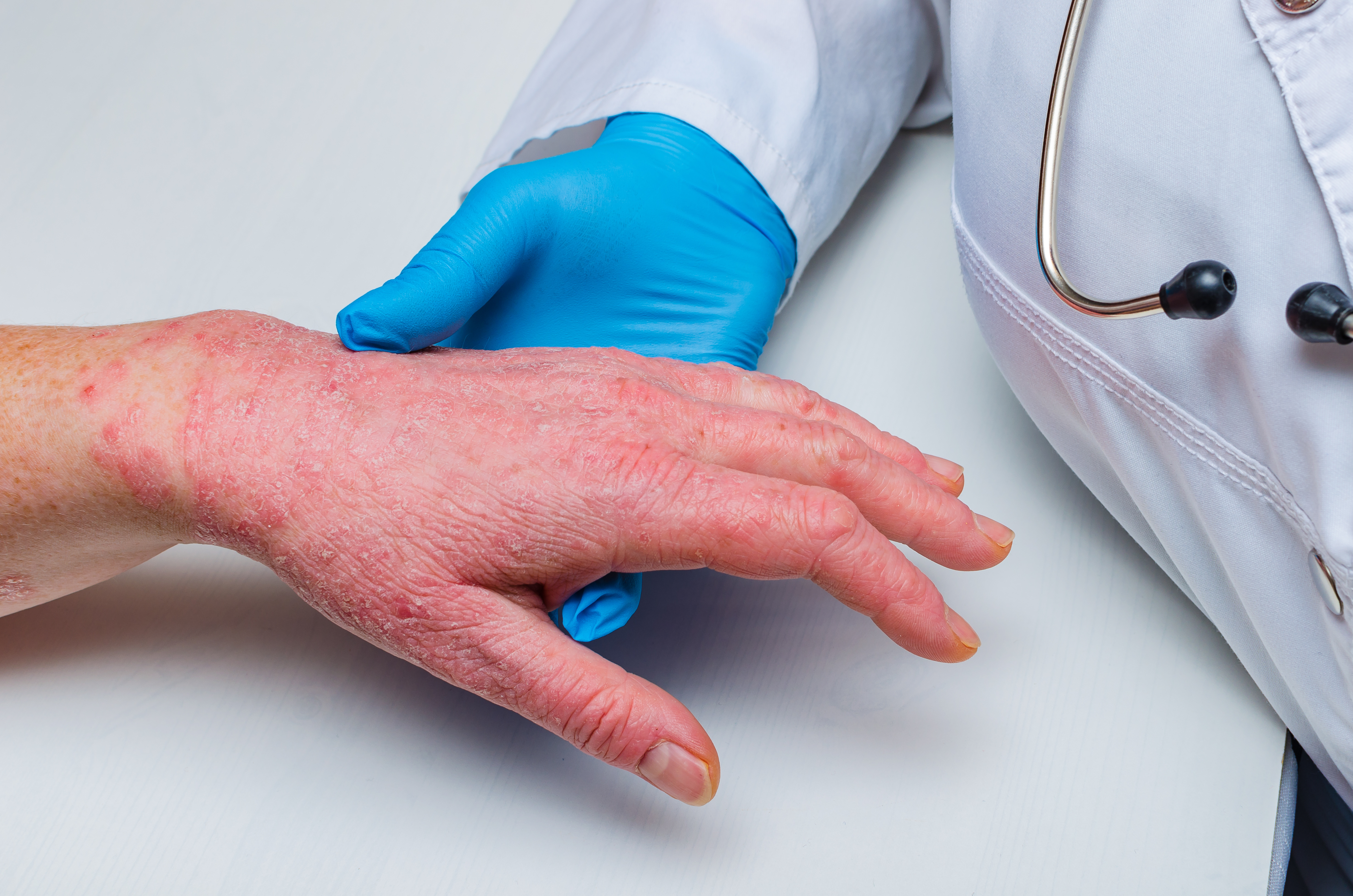 Therapeutic potential of cannabinoids in psoriasis symptom management