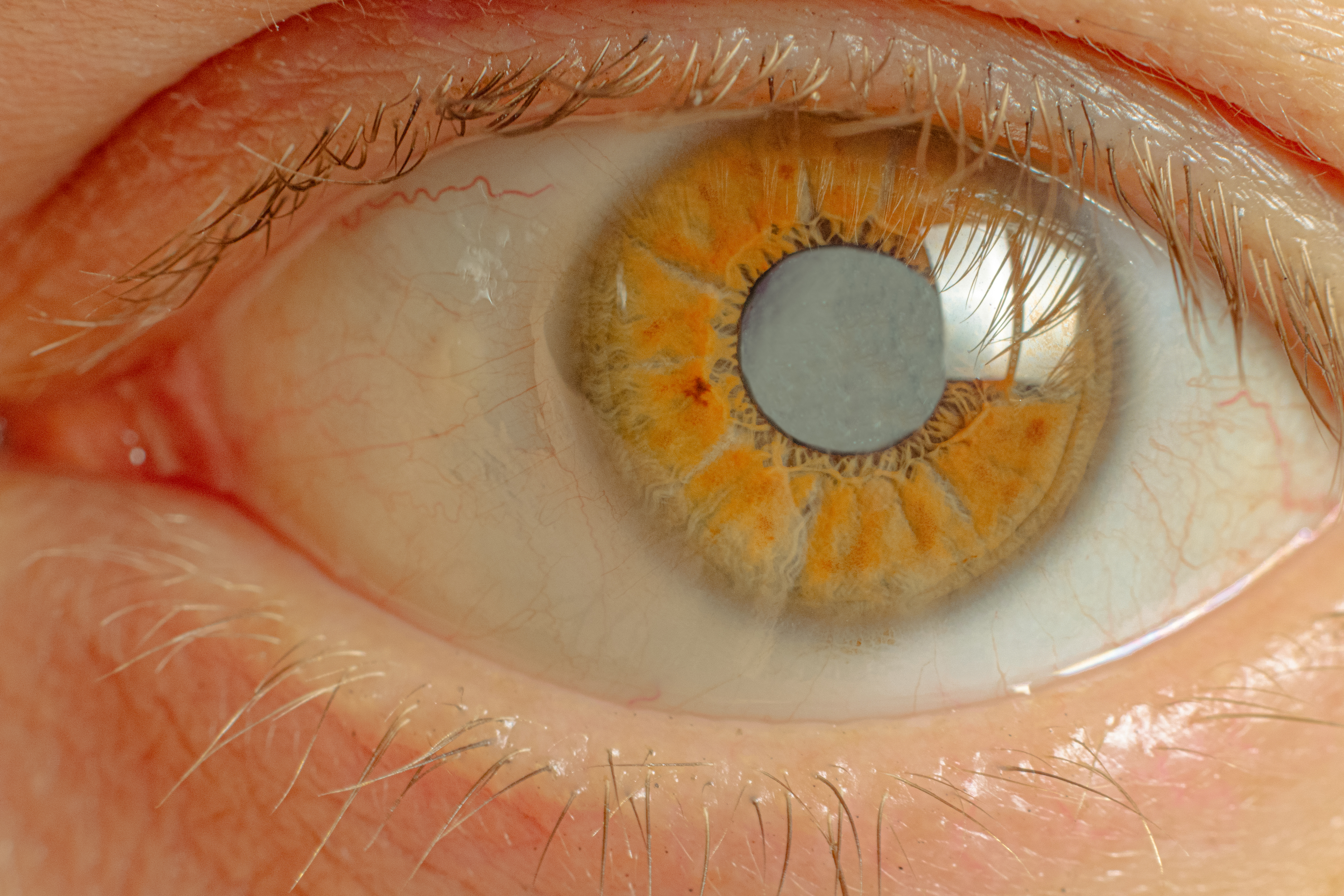 glaucoma