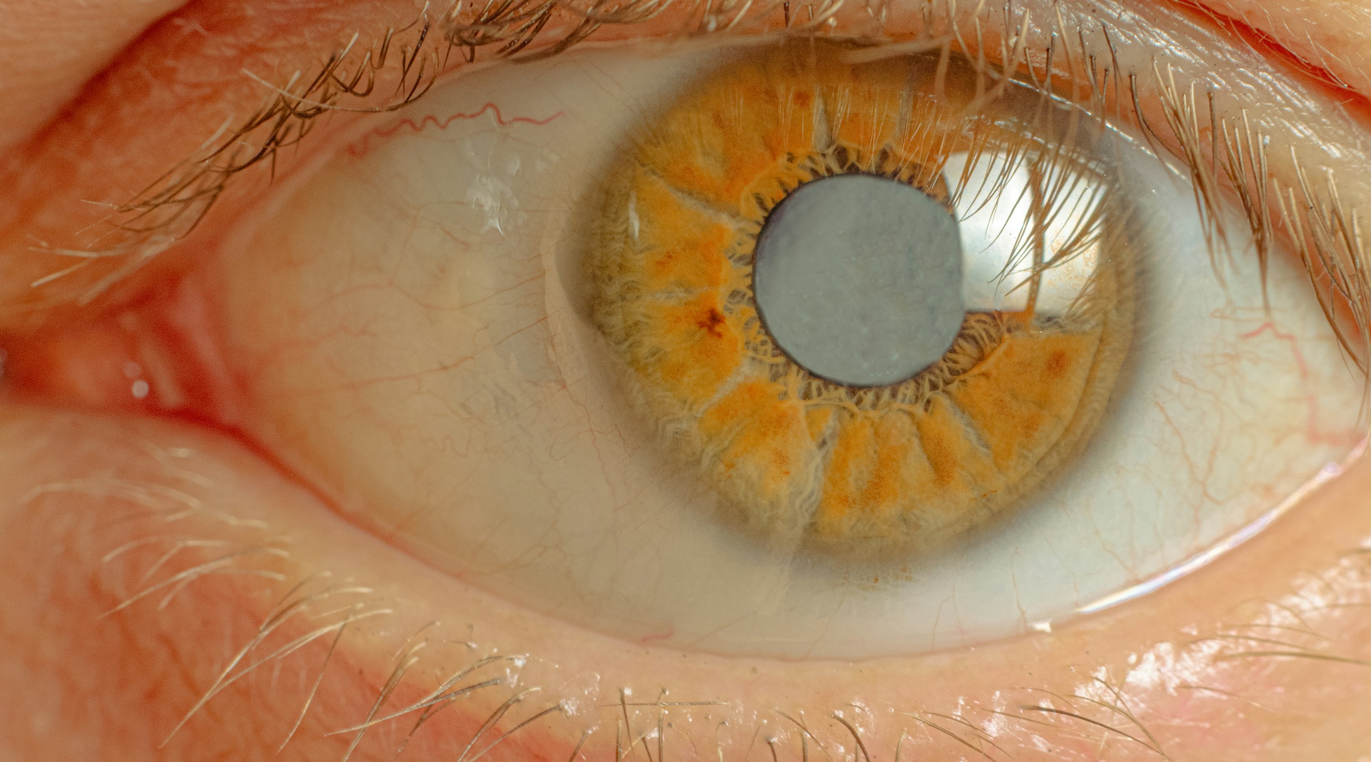 Can medicinal cannabis help sufferers of glaucoma? Can medicinal cannabis help sufferers of glaucoma?