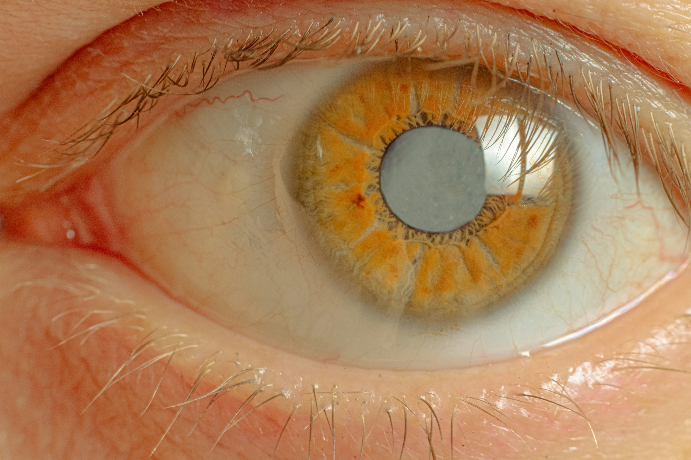Can medicinal cannabis help sufferers of glaucoma?