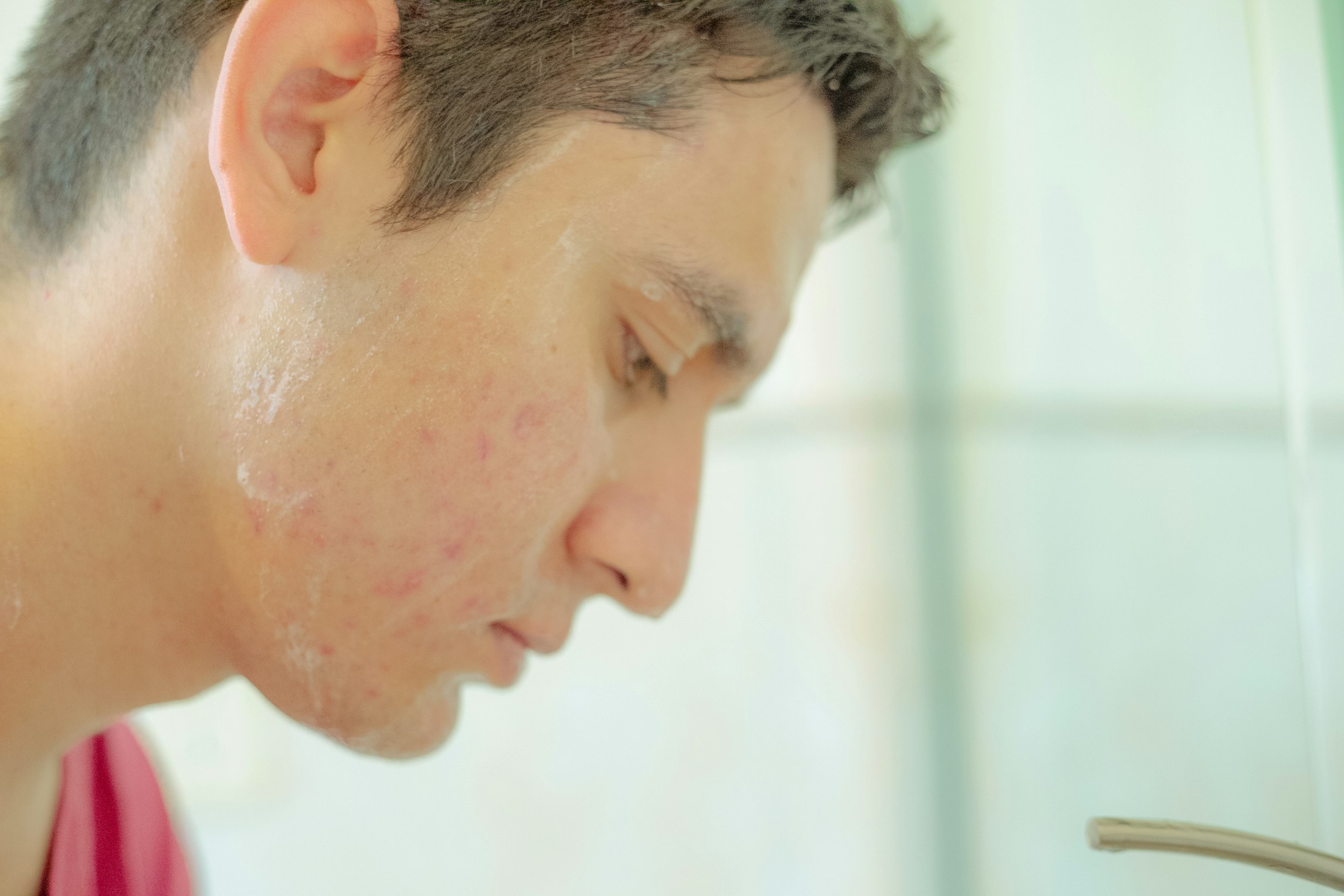 Does CBD offer potential therapeutic benefits for acne?