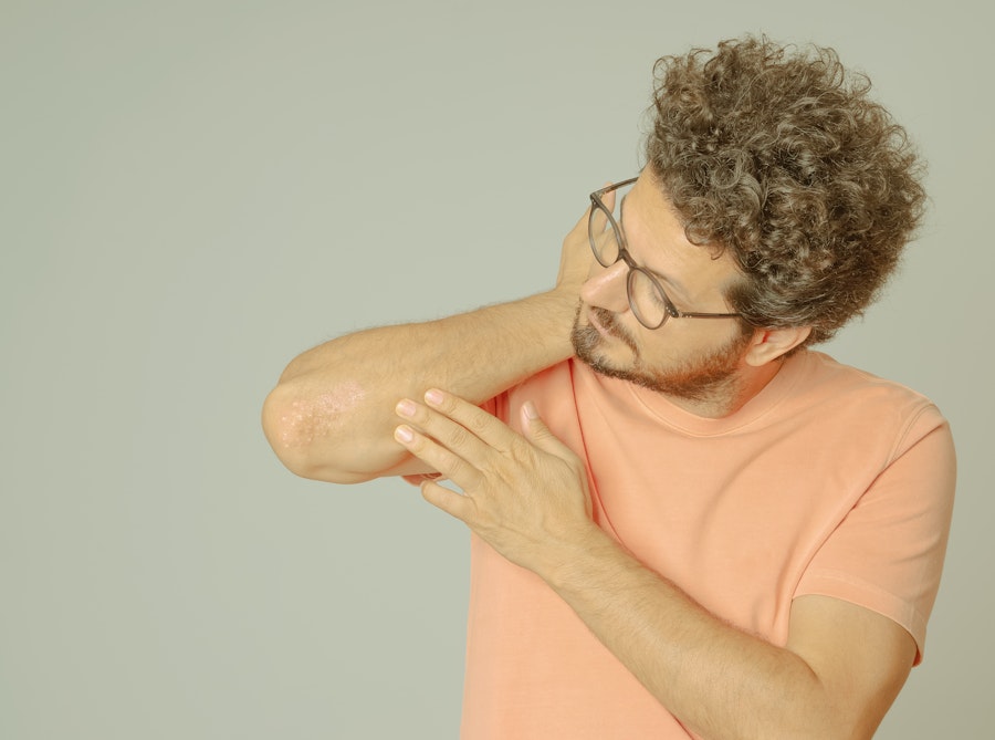 Unlocking the benefits of CBD oil for psoriasis
