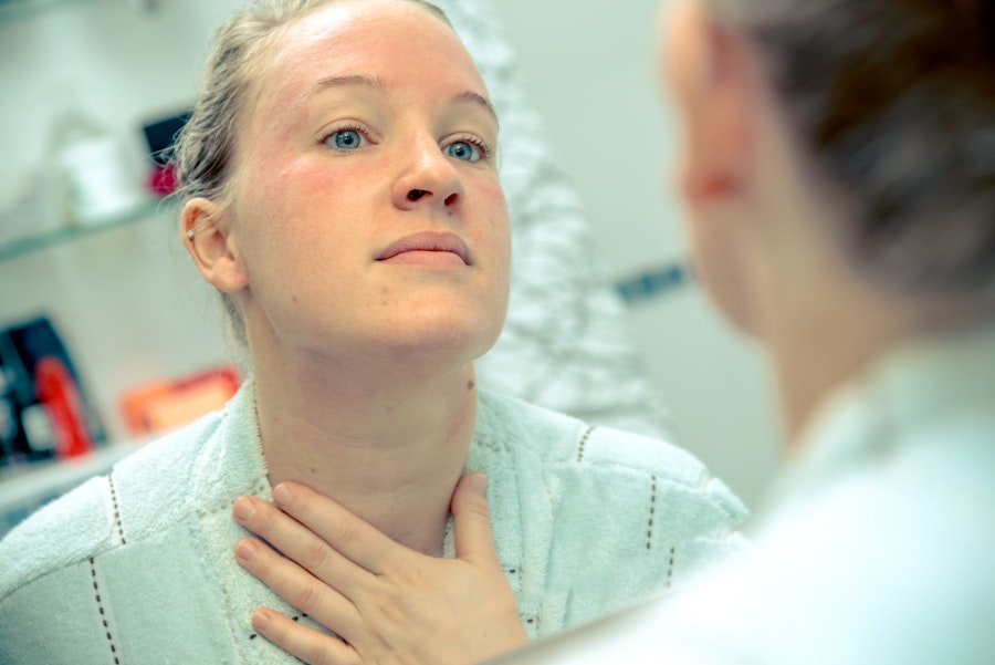 Cannabis and eczema - Five ways it can help