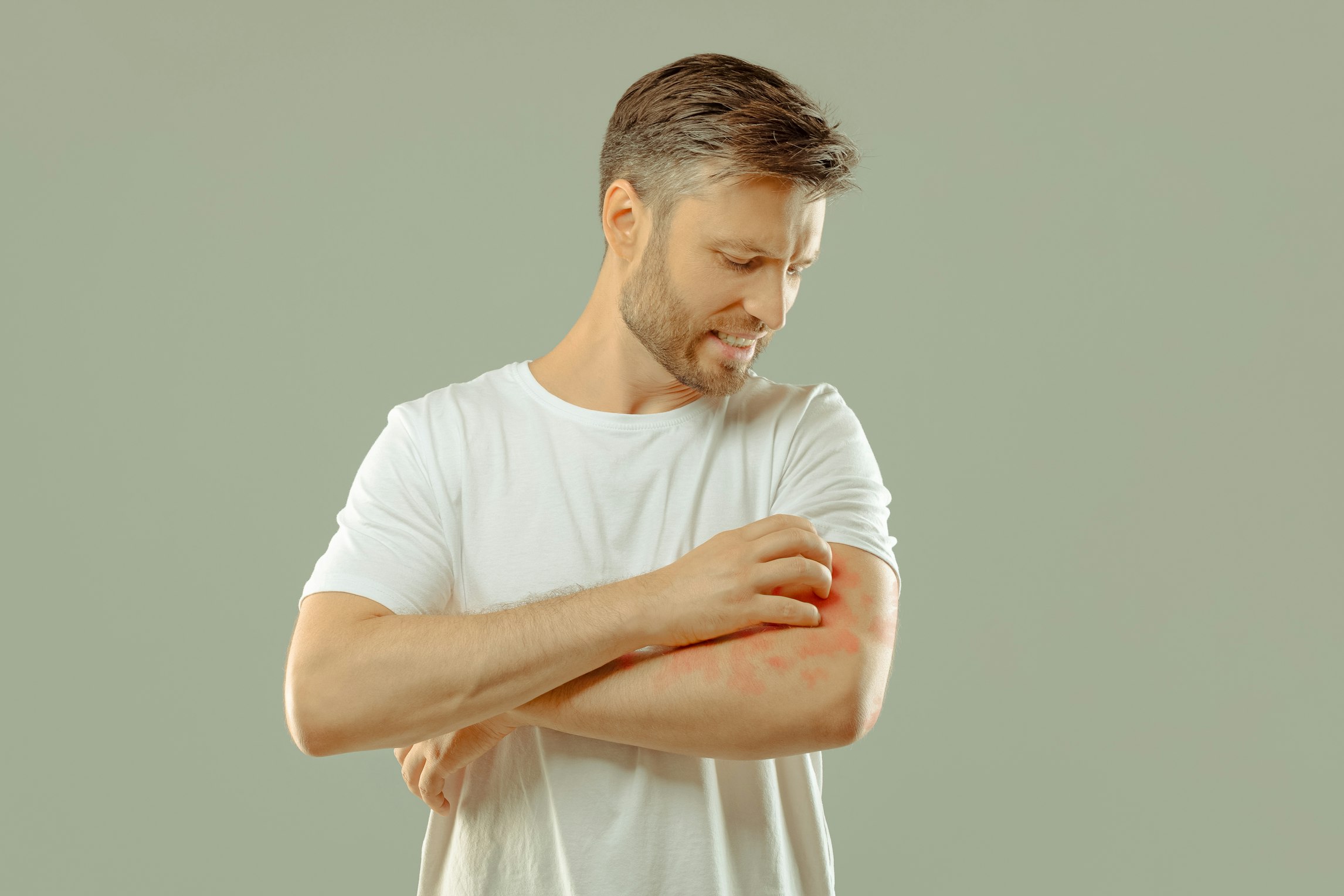 Can cannabis cream offer relief from psoriasis?