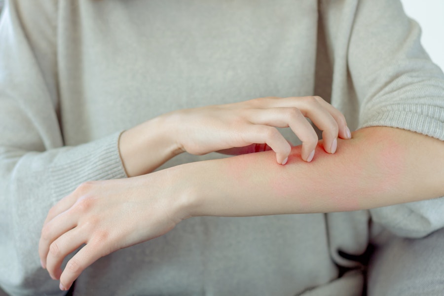 Is CBD good for itchy skin?