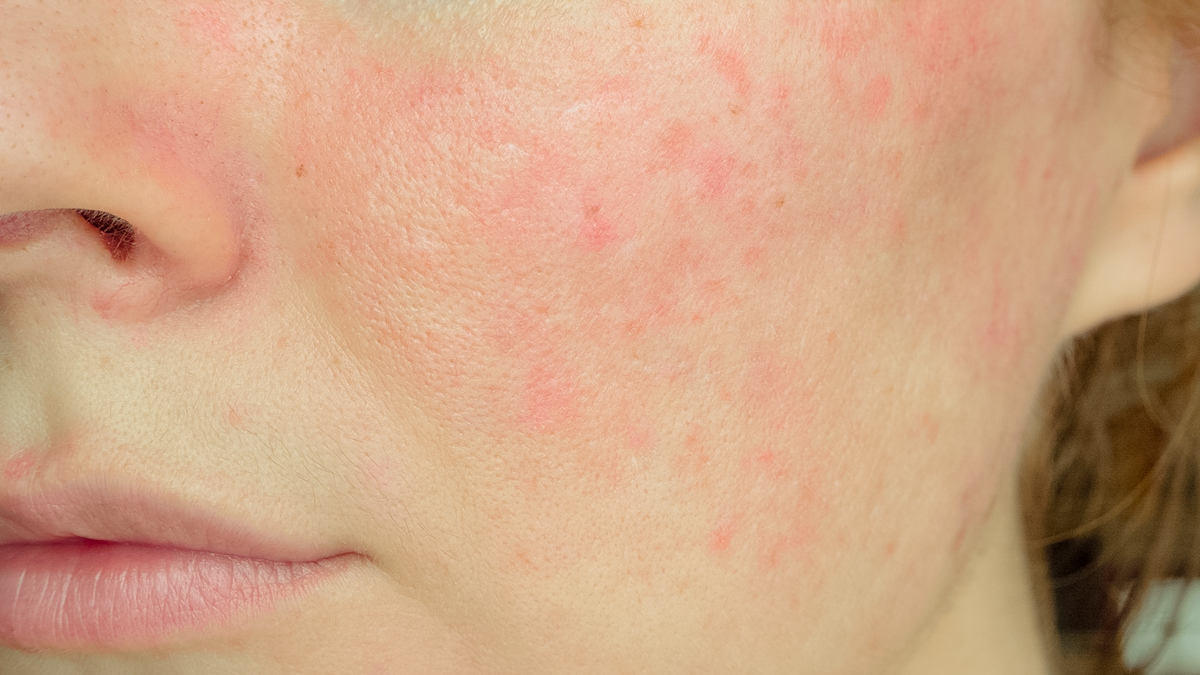 CBD rosacea