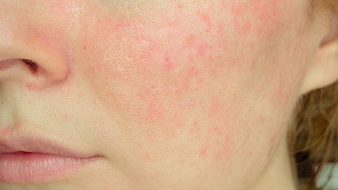 Medical cannabis, hemp, CBD for rosacea