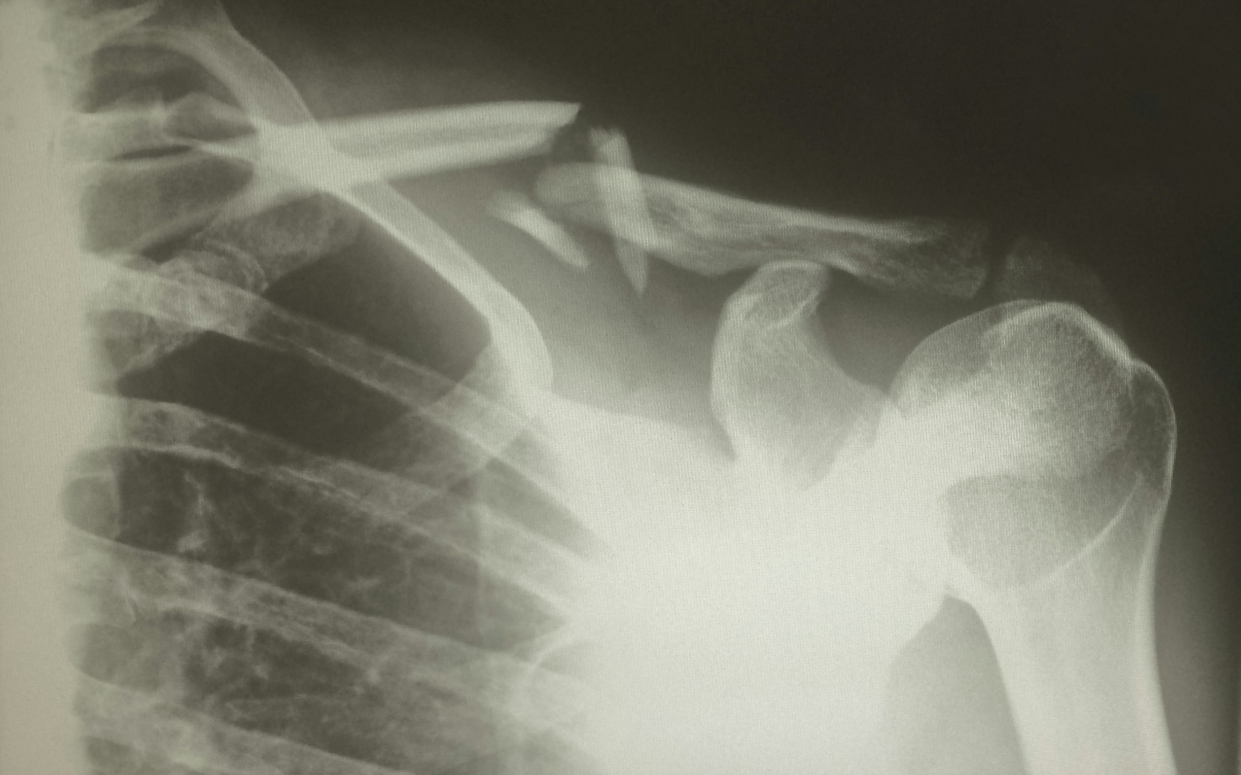 The science behind cannabinoids and bone regeneration
