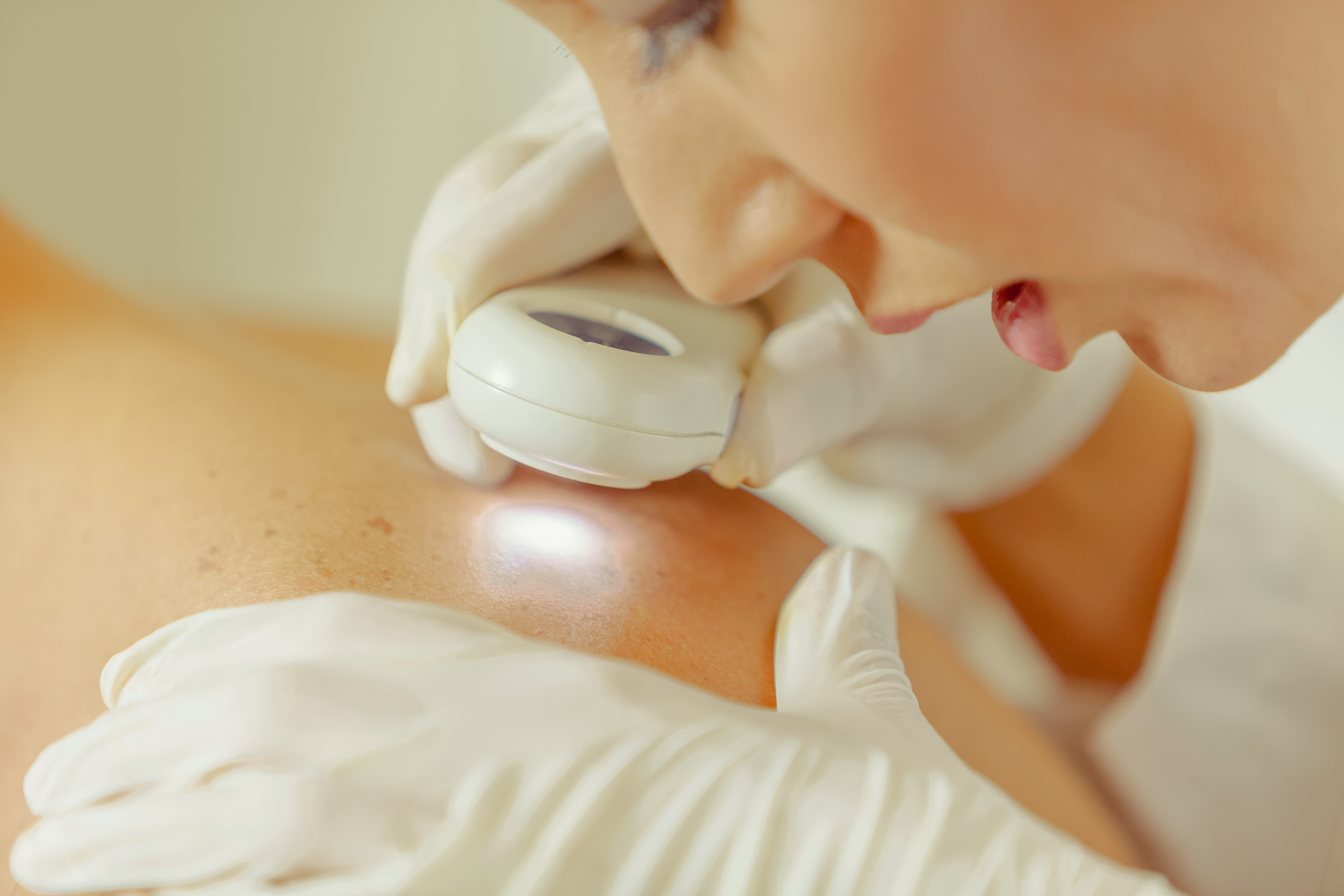 skin cancer
