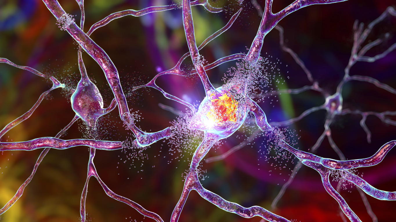 What is Parkinson’s disease?