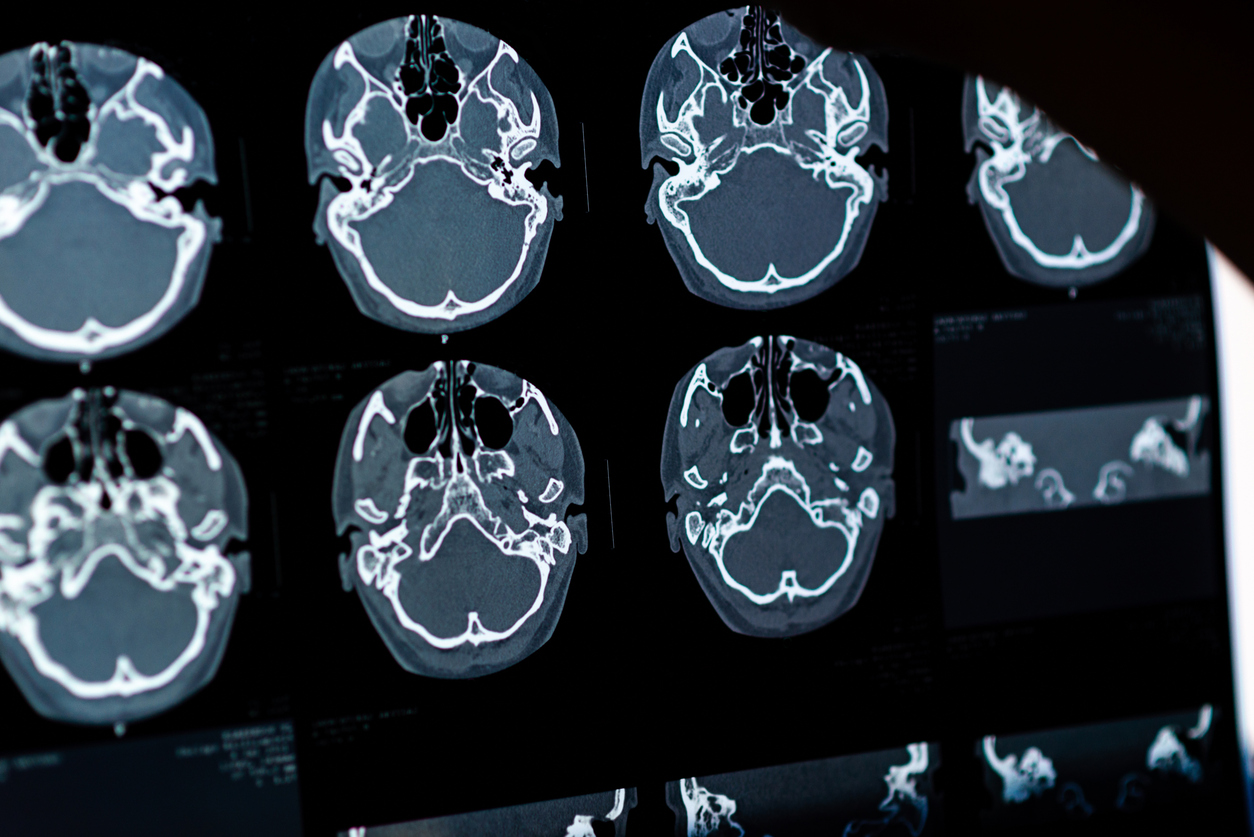 What causes Cerebral Palsy