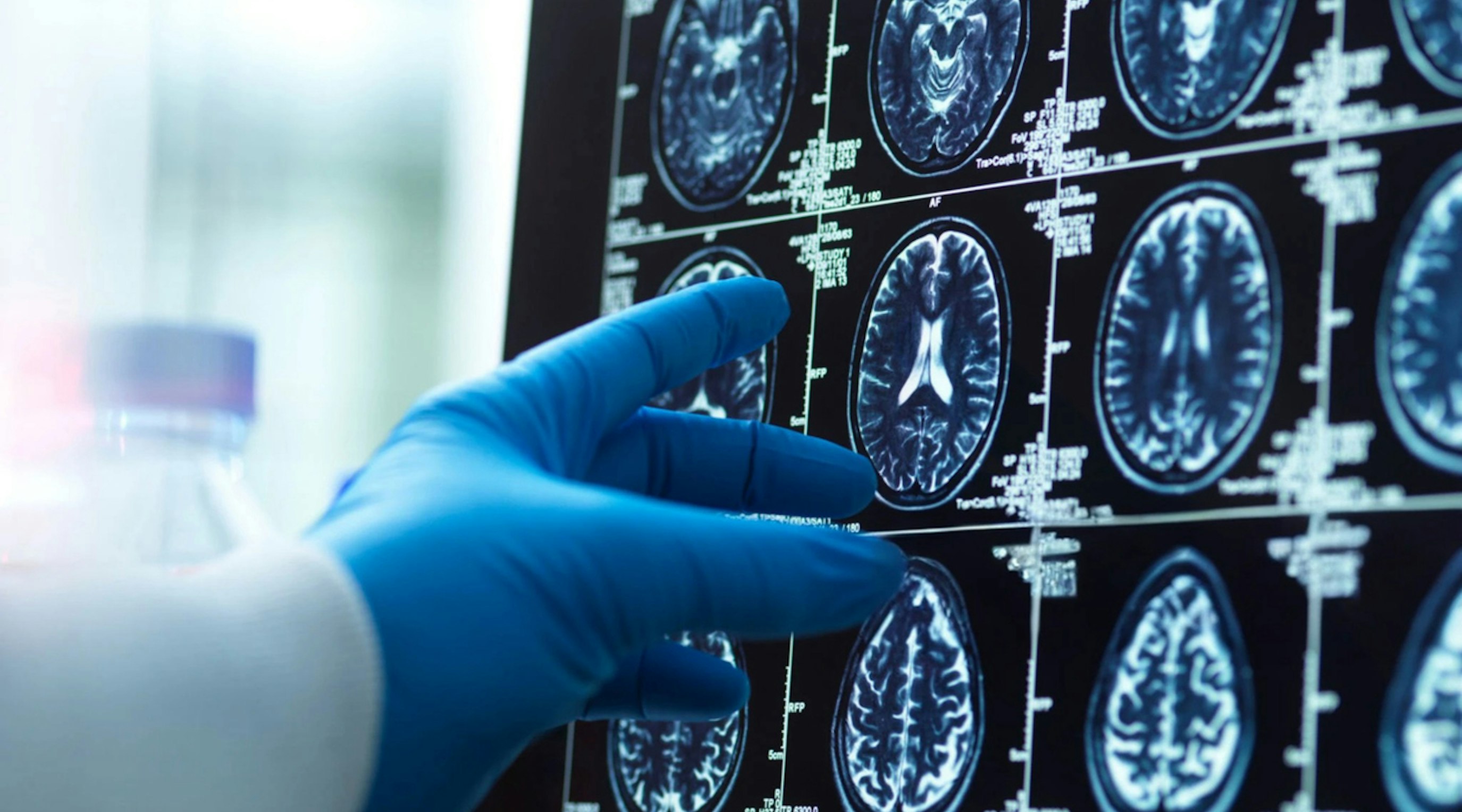 neurological conditions medical cannabis UK