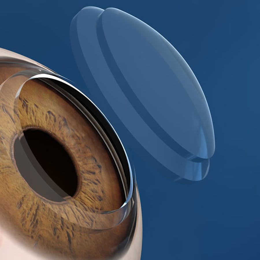 Cross linking corneale