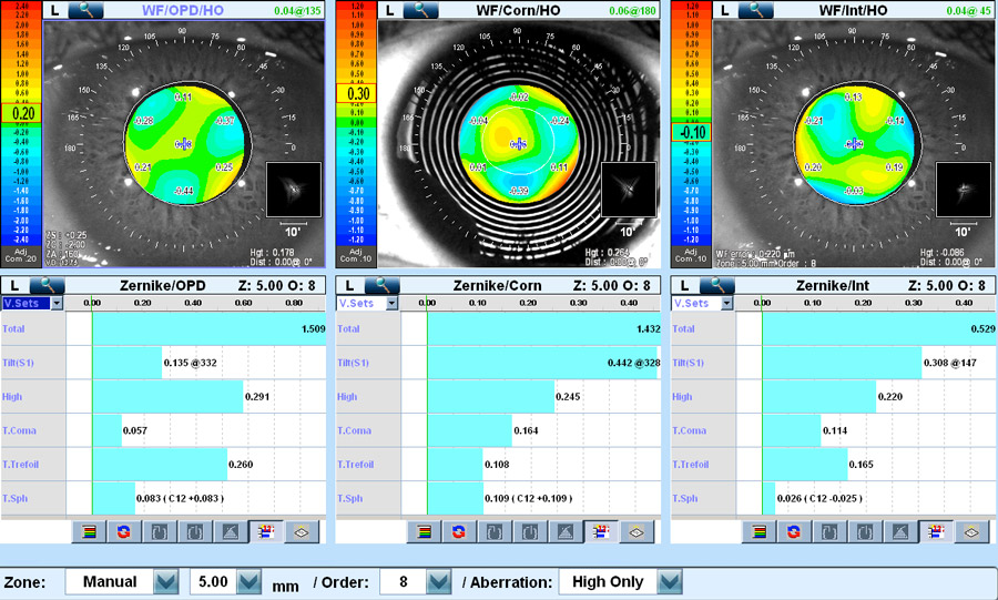 1547656157 vincieye aberrometria