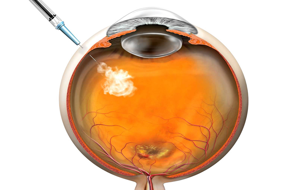 Iniezioni intravitreali 