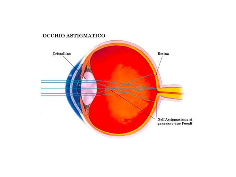 Astigmatismo sintomi, correzione con occhiali o facorefrattiva Centro Oculistico Firenze Astigmatismo sintomi, correzione con occhiali o facorefrattiva Centro Oculistico Firenze