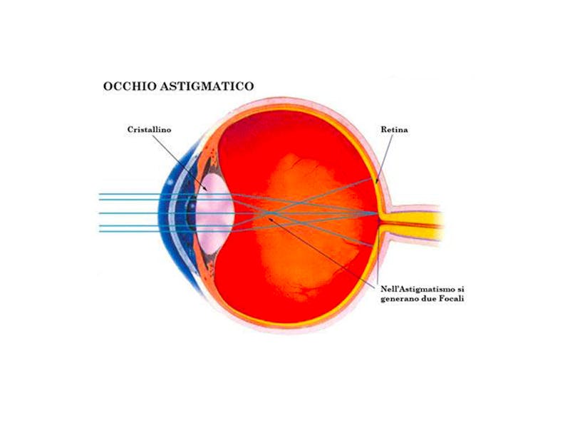 1554107513 occhio astigmatico