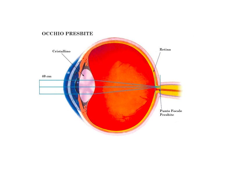 1554107535 occhio presbite