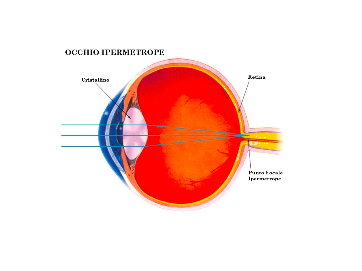1554107560 occhio ipermetrope