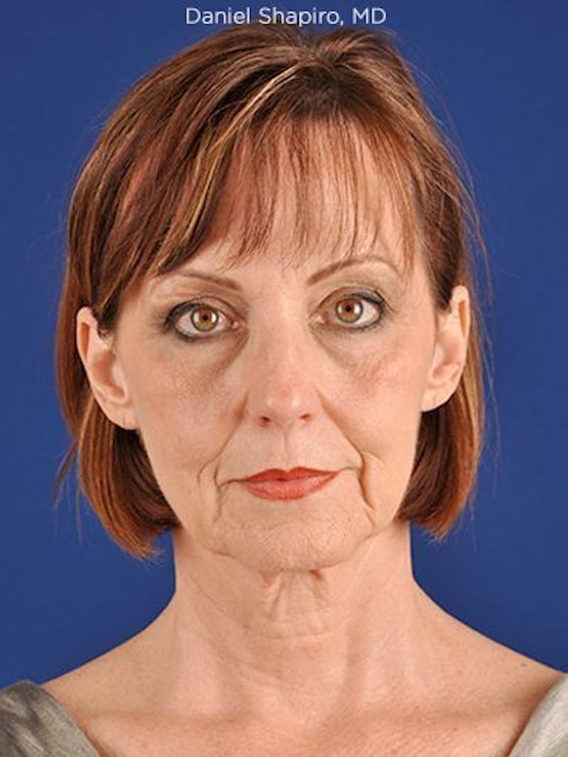Facelift Before & After Gallery - Patient 10669892 - Image 1