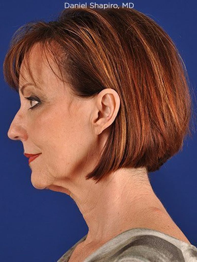 Facelift Before & After Gallery - Patient 10669892 - Image 5