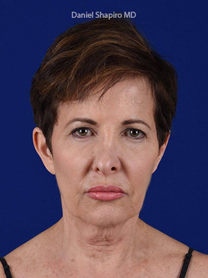 Facelift Before & After Gallery - Patient 10669898 - Image 1