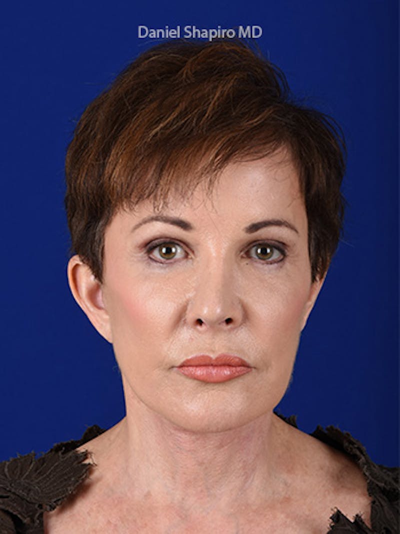 Facelift Before & After Gallery - Patient 10669898 - Image 2