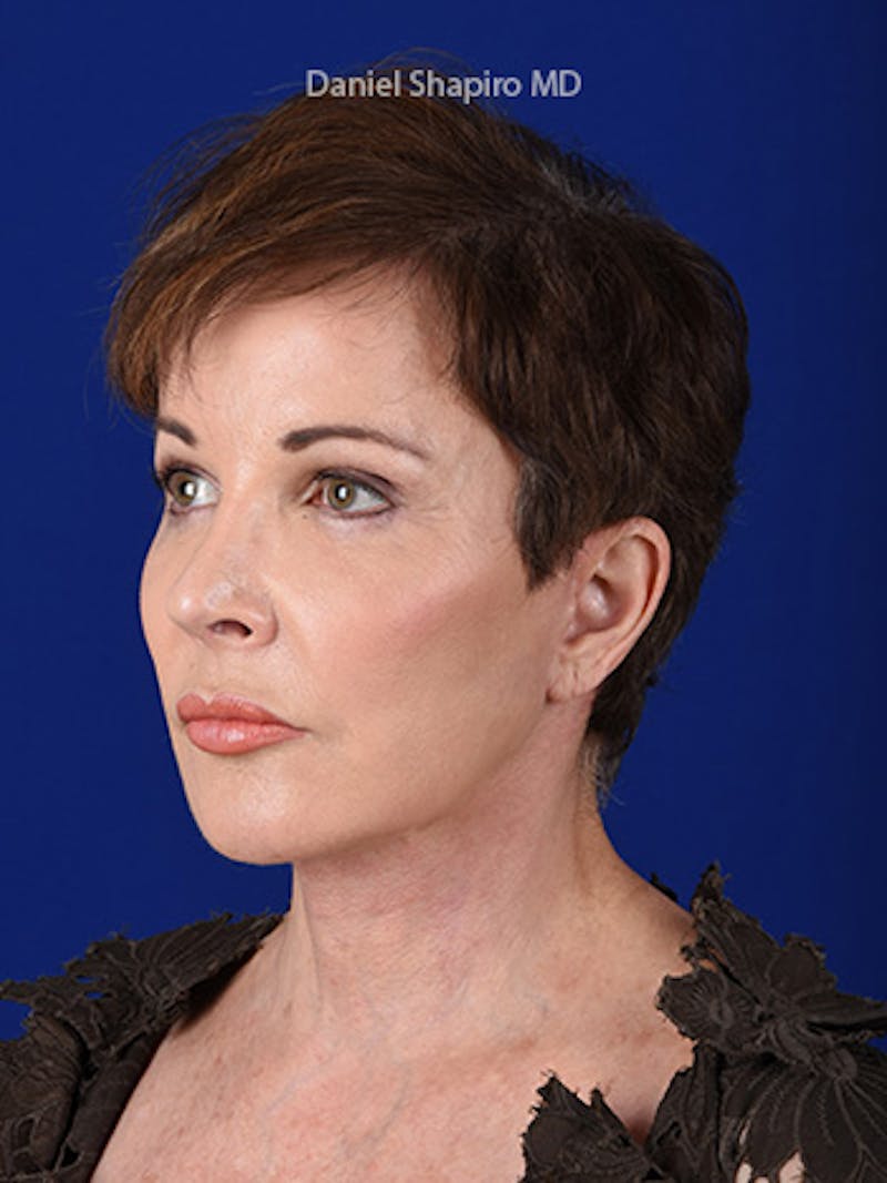 Facelift Before & After Gallery - Patient 10669898 - Image 4