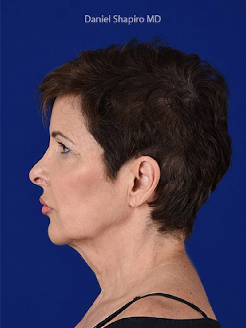 Facelift Before & After Gallery - Patient 10669898 - Image 5