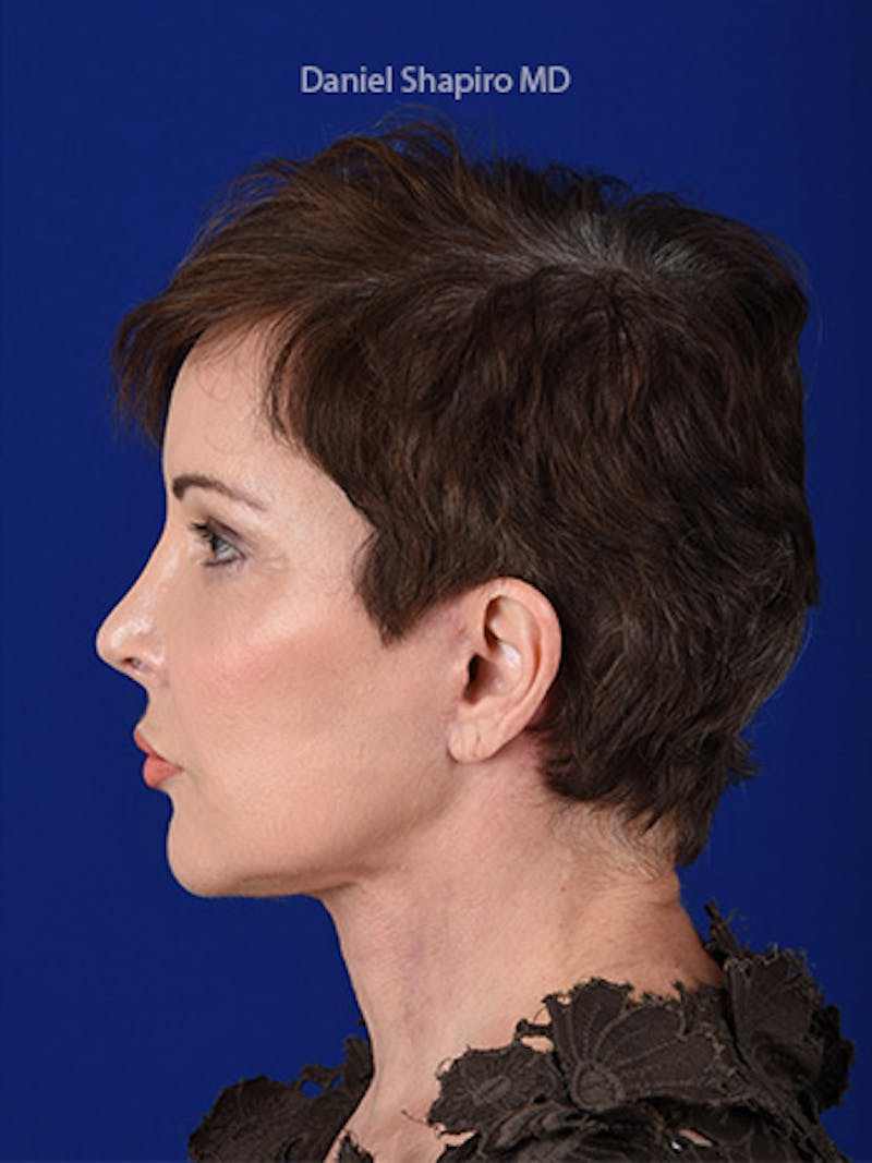 Facelift Before & After Gallery - Patient 10669898 - Image 6