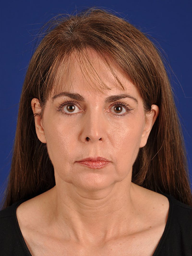 Facelift Before & After Gallery - Patient 10669905 - Image 1