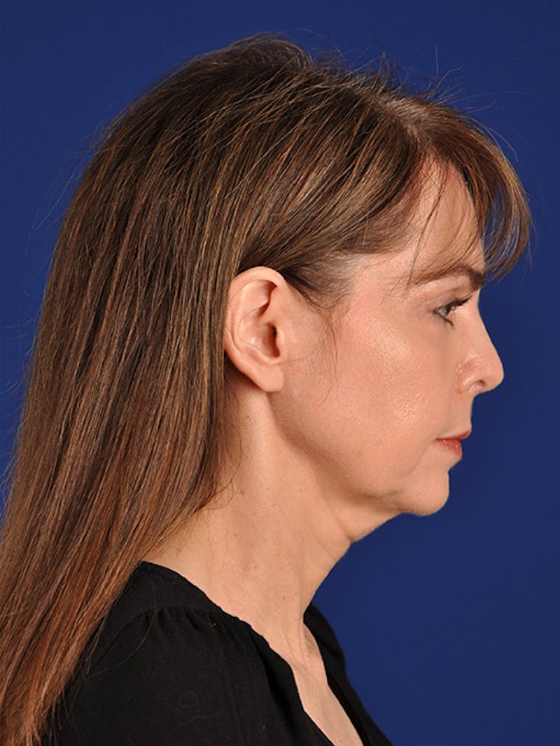 Facelift Before & After Gallery - Patient 10669905 - Image 5
