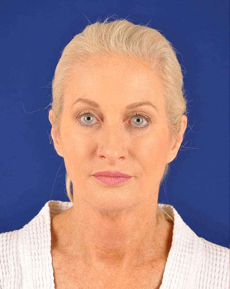 Facelift Before & After Gallery - Patient 10669910 - Image 1
