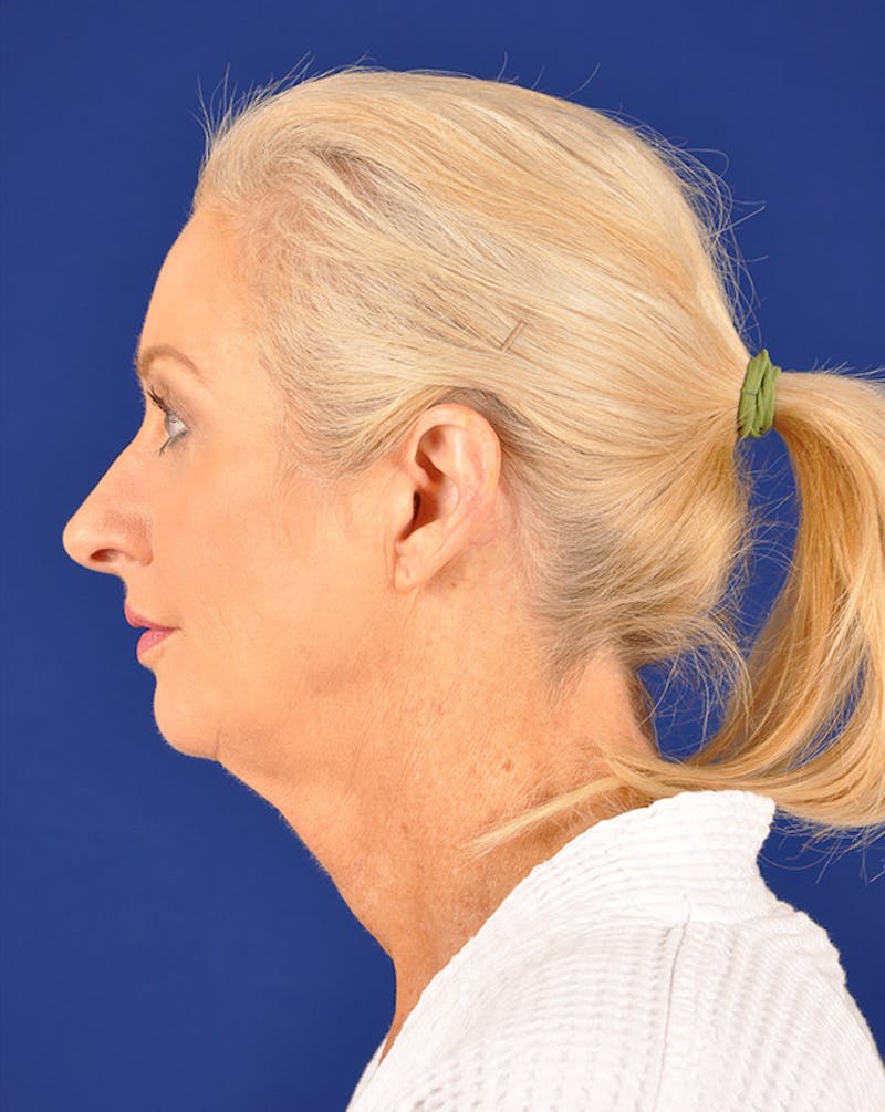 Facelift Before & After Gallery - Patient 10669910 - Image 5