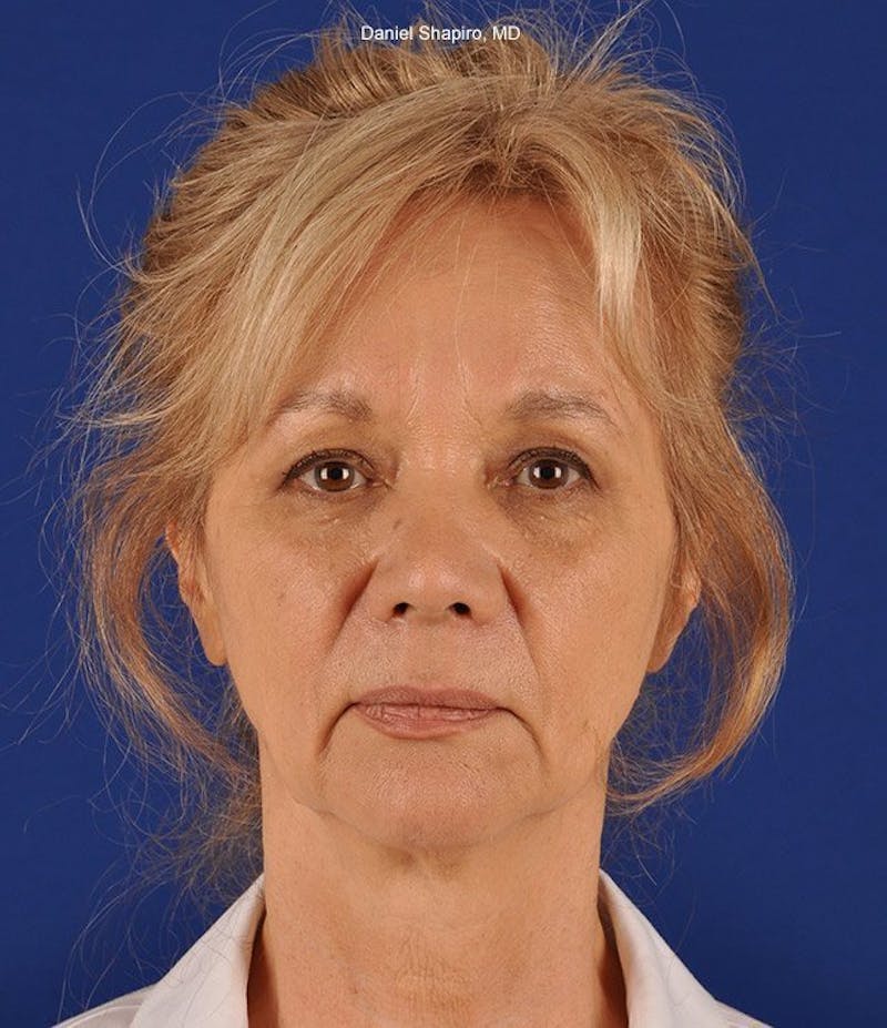 Facelift Before & After Gallery - Patient 10669916 - Image 1