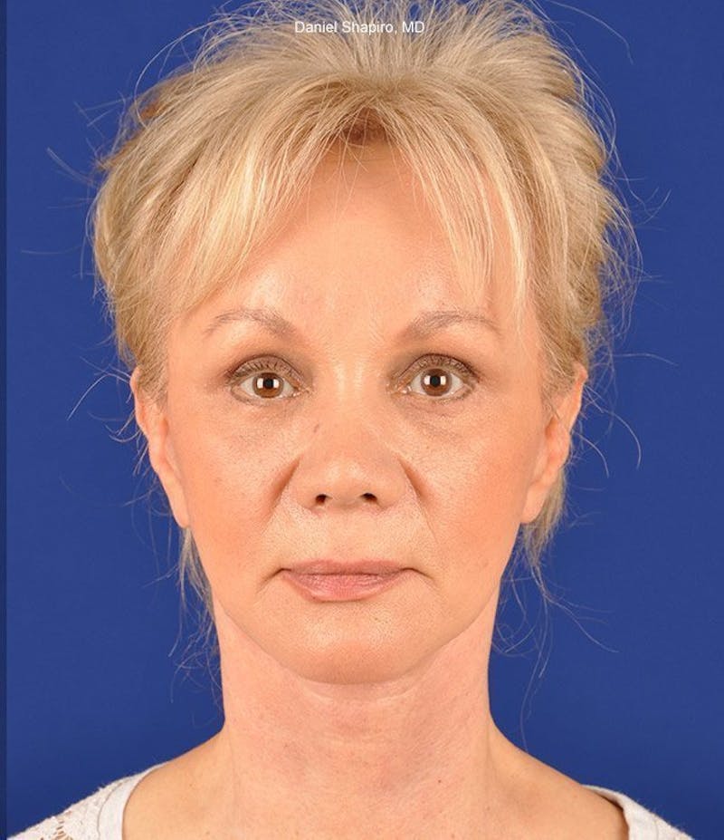 Facelift Before & After Gallery - Patient 10669916 - Image 2