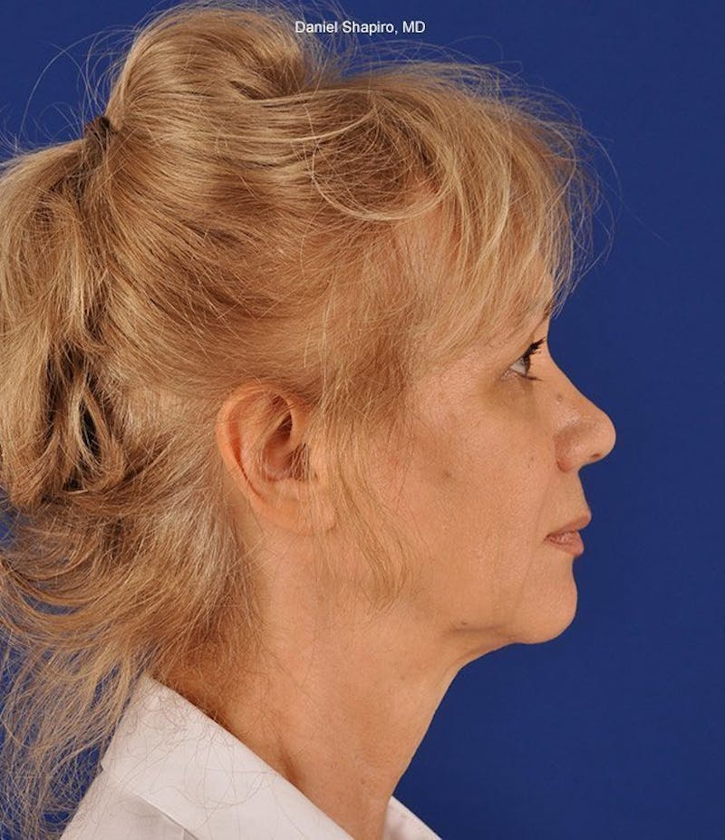 Facelift Before & After Gallery - Patient 10669916 - Image 5