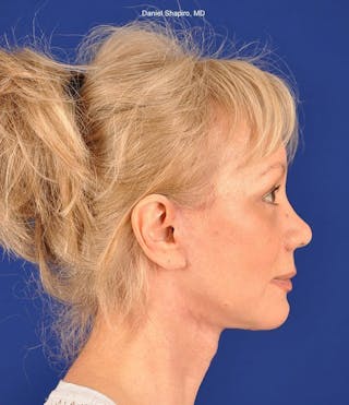 Facelift Before & After Gallery - Patient 10669916 - Image 6
