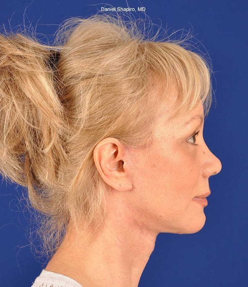Facelift Before & After Gallery - Patient 10669916 - Image 6