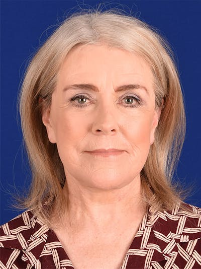 Facelift Before & After Gallery - Patient 10669922 - Image 2