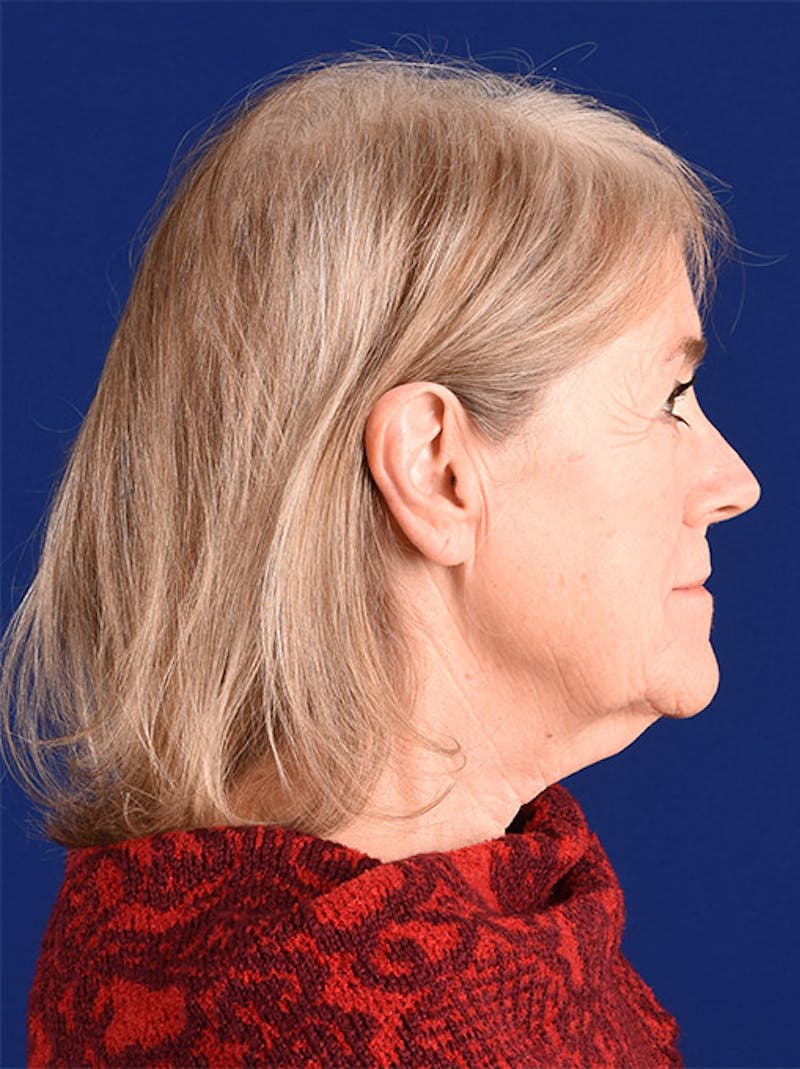 Facelift Before & After Gallery - Patient 10669922 - Image 5