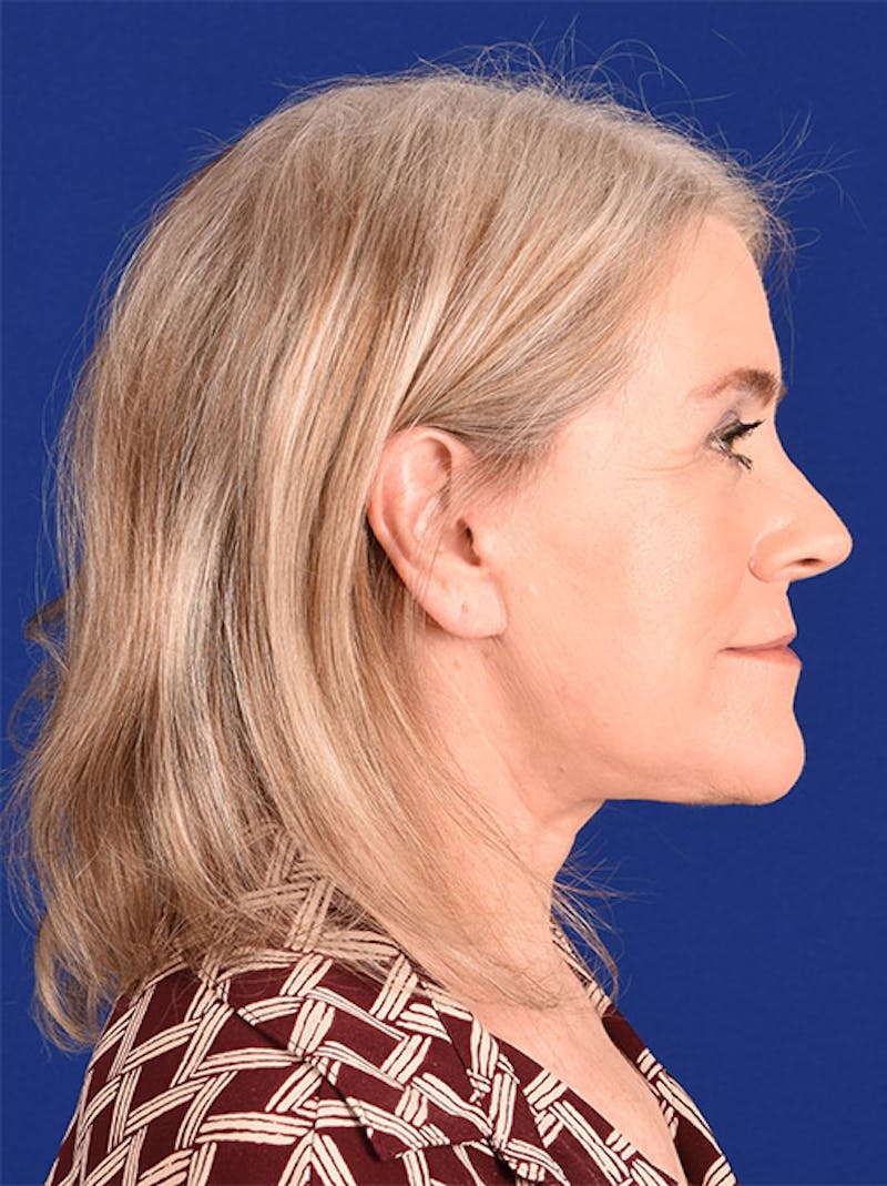 Facelift Before & After Gallery - Patient 10669922 - Image 6