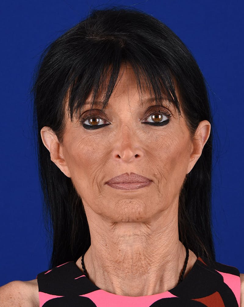 Facelift Before & After Gallery - Patient 10669928 - Image 1