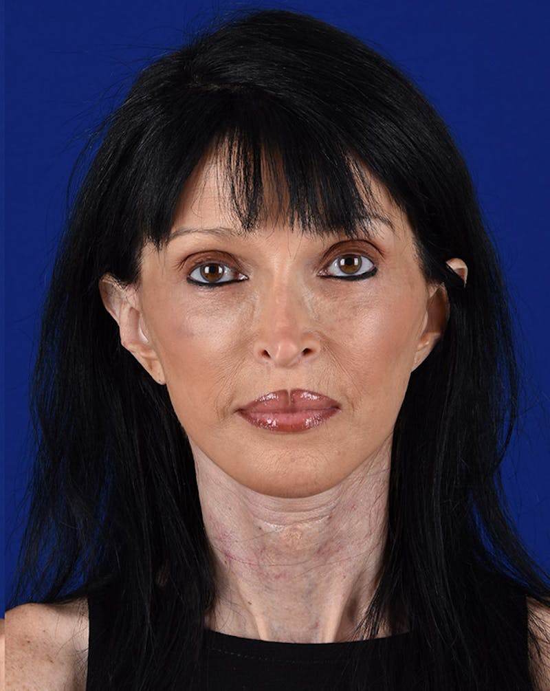 Facelift Before & After Gallery - Patient 10669928 - Image 2