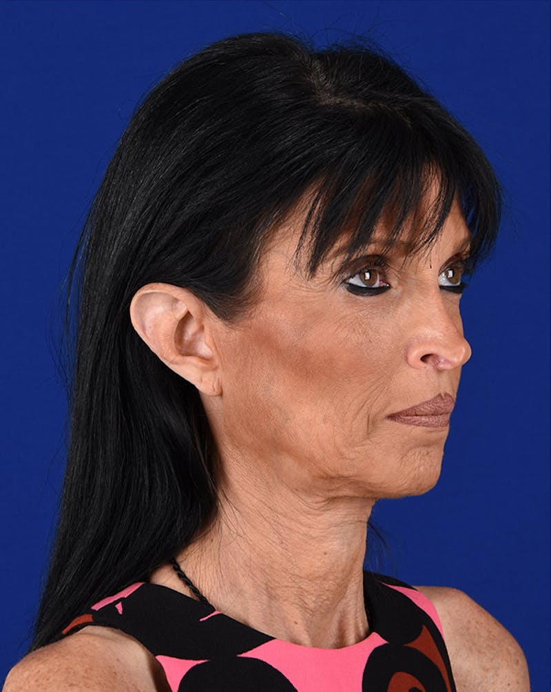 Facelift Before & After Gallery - Patient 10669928 - Image 3